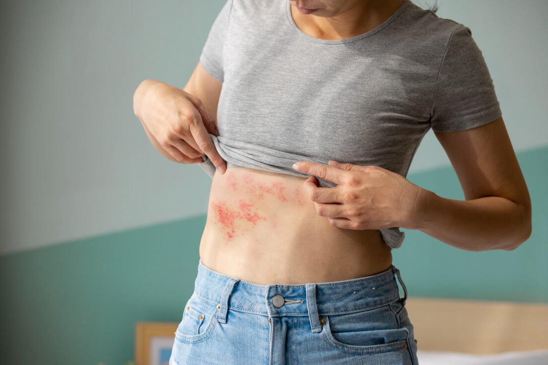 Shingles rash on torso