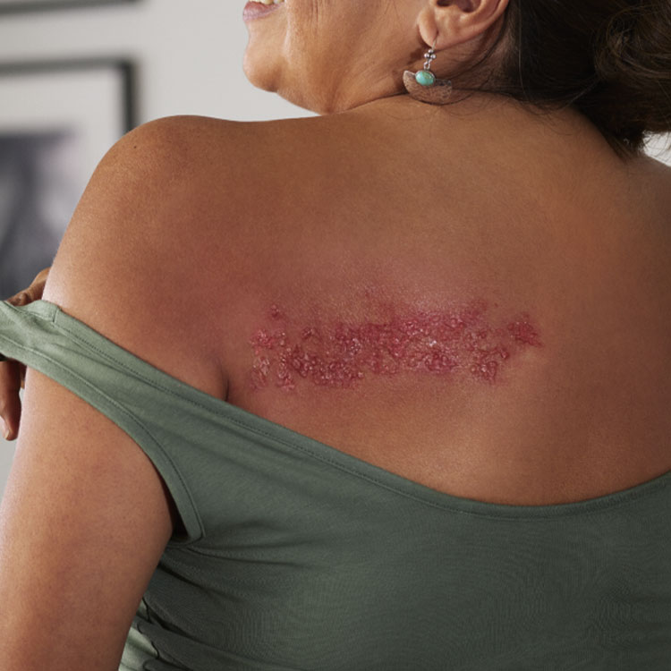 Close-up of rash on upper back.