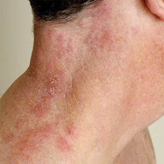 Close-up of rash on neck.